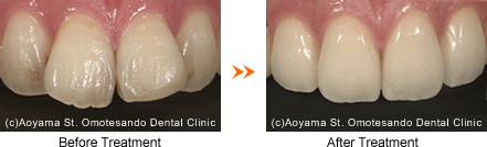 Zirconia crown