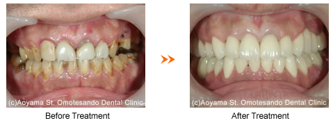 Pre dental treatment・ Post dental treatment