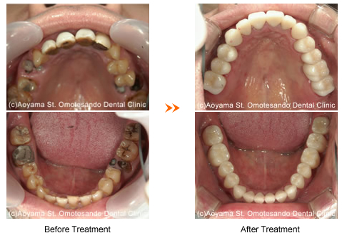 Before oral treatment・After oral treatment