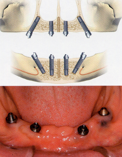 オールオンフォー（All-On-4） 1日で噛めるインプラント