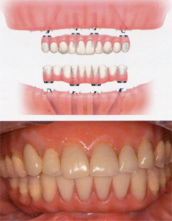 オールオンフォー（All-On-4） 1日で噛めるインプラント