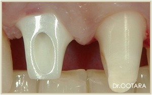 ジルコニア アバットメント