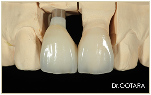 インプラント　技工