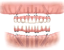 オールオンフォー（All-On-4） 1日で噛めるインプラント