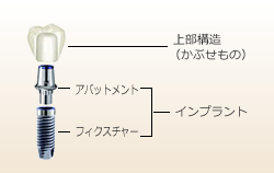 インプラントの構造