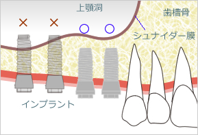 サイナスリフト