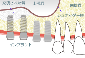 サイナスリフト