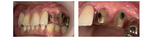インプラント・アバットメント