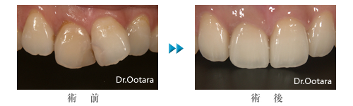 前歯を差し歯にした例