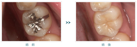 銀歯を白くする