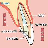 インターナル